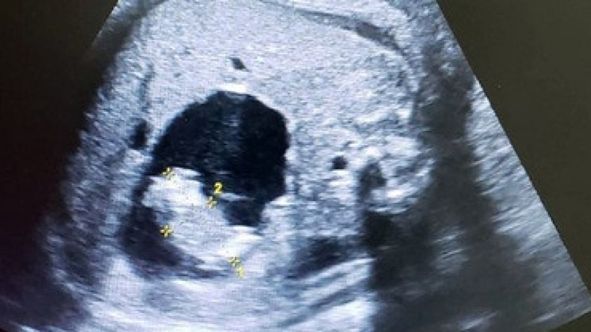 Hindistan’da doğmamış bebeğin karnında iki fetüs bulundu